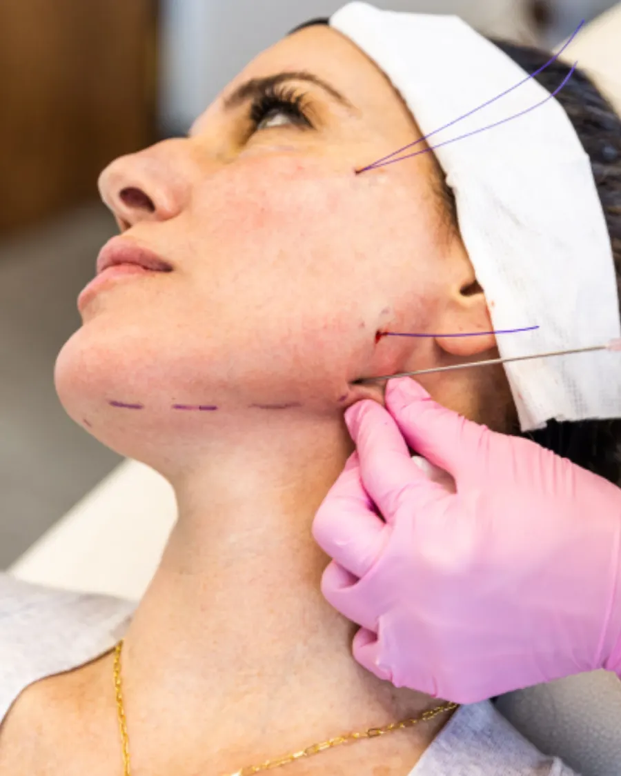 Thread Lift at Cinch Clinics